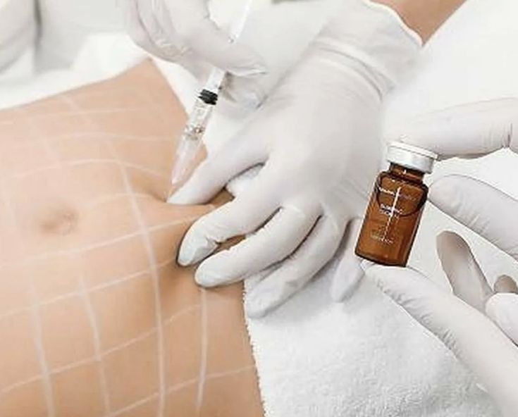 Lipotuck vs. Traditional Tummy Tuck: Which One Is Right for You?
